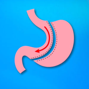 Austin Gastric Sleeve